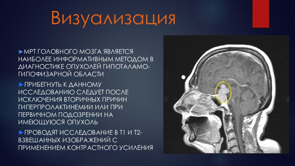 Презентация на тему гиперпролактинемия