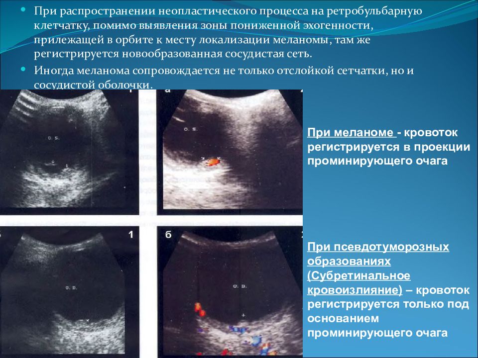 Неопластический процесс. Меланома хориоидеи УЗИ.