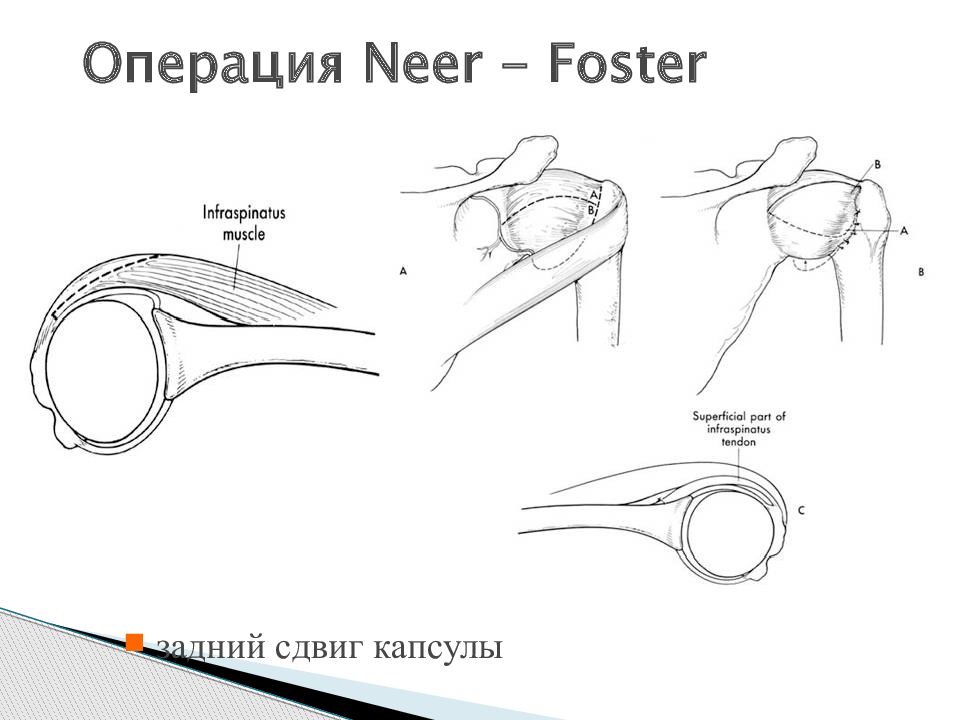 Задний вывих плечевой кости. Акромиопластика плечевого сустава. Привычный вывих плеча операция.