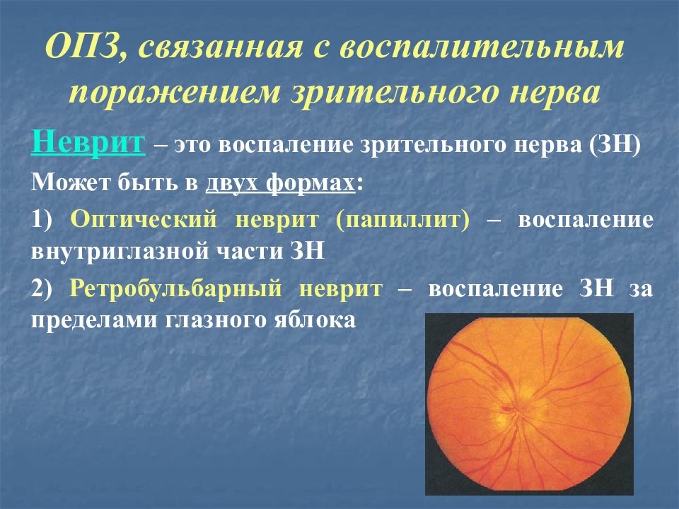 Ретробульбарный неврит симптомы. Ретробульбарный неврит (папиллит). ретробульбарный неврит зрительного нерва симптомы. ретробульбарный неврит зрение.