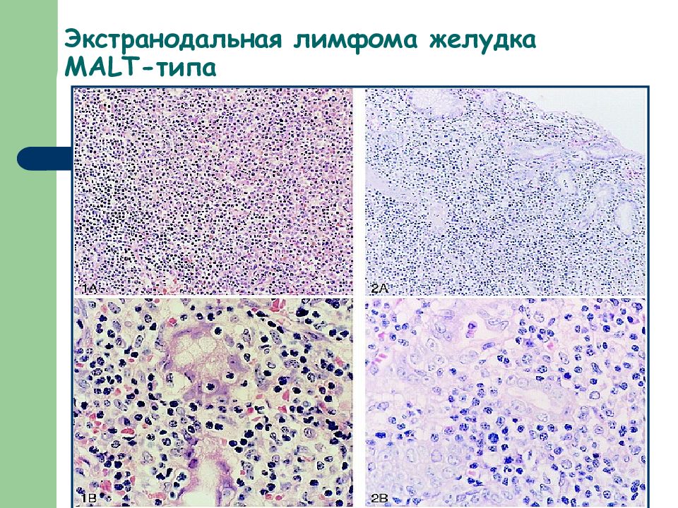 Лимфома кишки