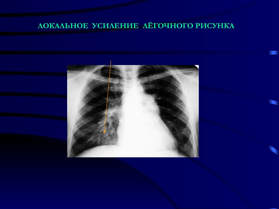 Усиление легочного. Усиление легочного рисунка. Усиленный легочный рисунок. Локально усилен легочный рисунок. Локальное усиление легочного рисунка.