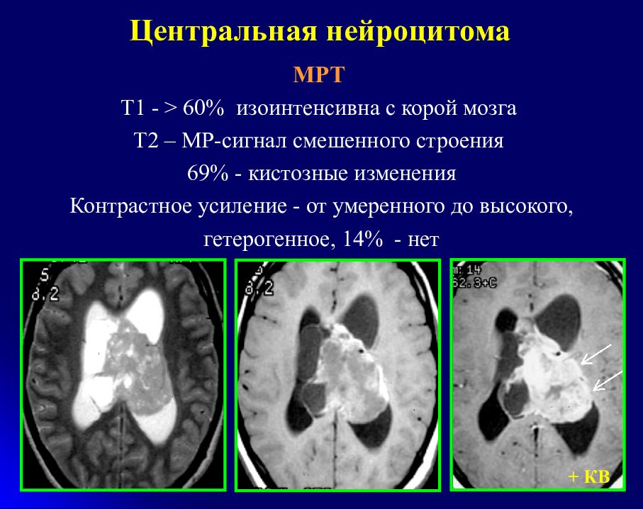 Т2 изображение в мрт