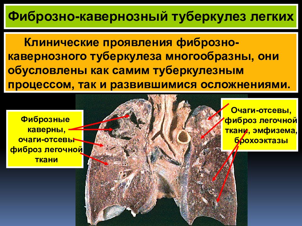 Лечение фиброза легких препараты. Кавернозный туберкулез легкого. Макропрепарат. Фиброзно кавернозный туберкулез патологическая анатомия. Фиброзно-кавернозный туберкулез легких симптомы. Фиброзный каверзионый турбекулез.