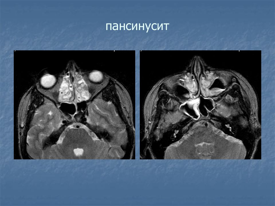 Гиперпластический синусит кт. Сфеноидит кт мрт.