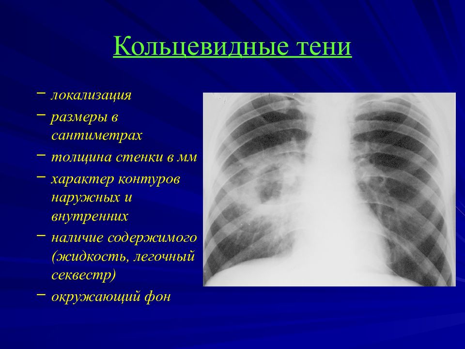 Лучевая диагностика средостения презентация