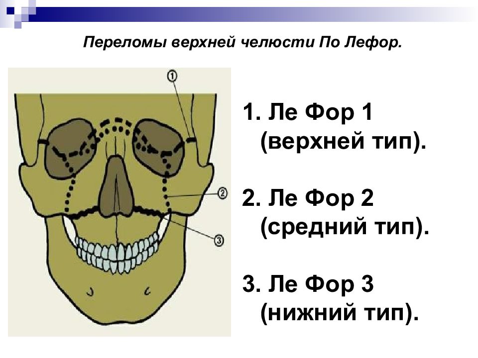 Переломы верхней и нижней челюсти презентация