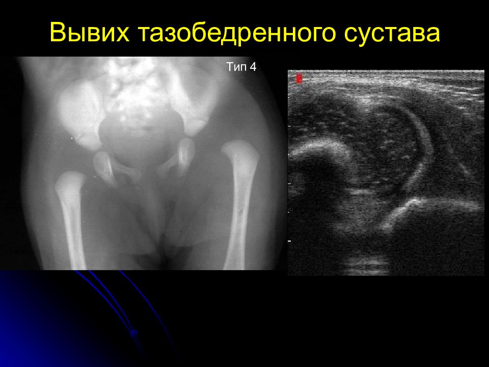 Узи тазобедренного. Врожденный вывих бедра УЗИ. Дисплазия тазобедренных суставов УЗИ. УЗИ тазобедренного сустава у взрослых.