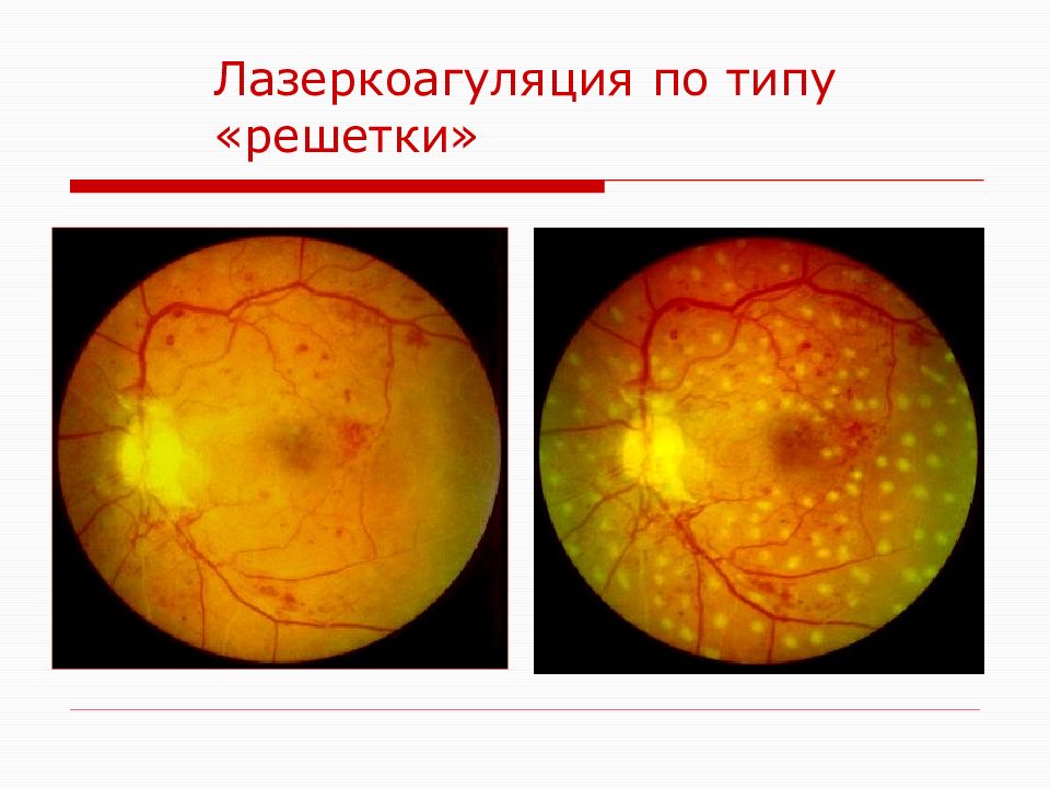 Глаз после лазерной коагуляции сетчатки. Диабетическая ретинопатия сетчатки глаза. Периферическая лазеркоагуляция сетчатки глаза. Лазеркоагуляция сетчатки при диабетической ретинопатии. Панретинальная лазерокоагуляция.