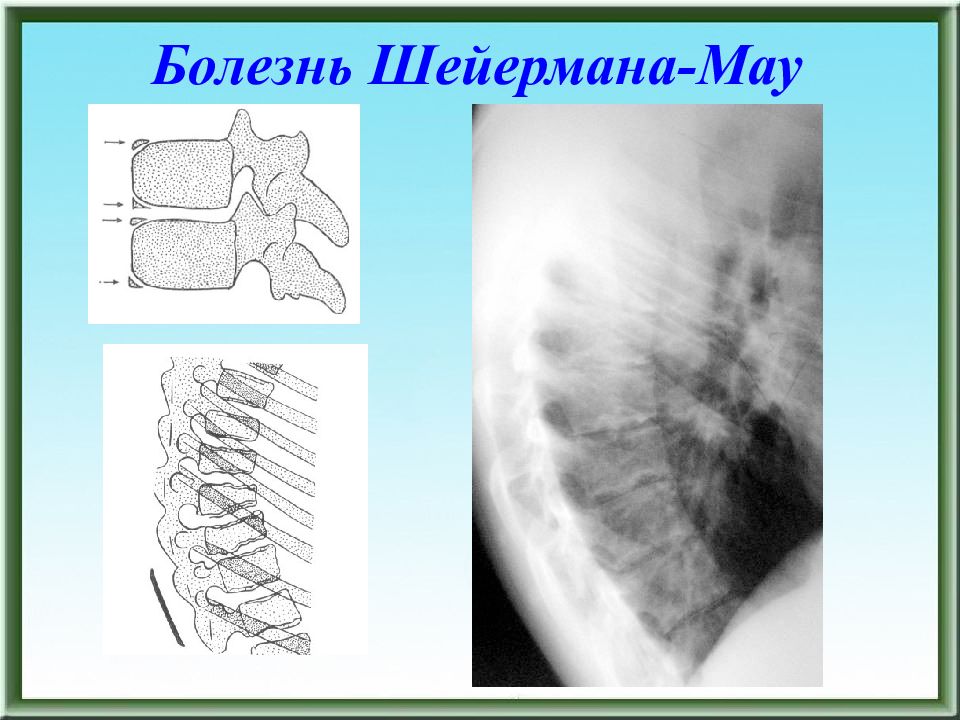 Болезнь шейермана мау. Шойермана-МАУ рентгенодиагностика. Спондилопатия Шойерман МАУ.