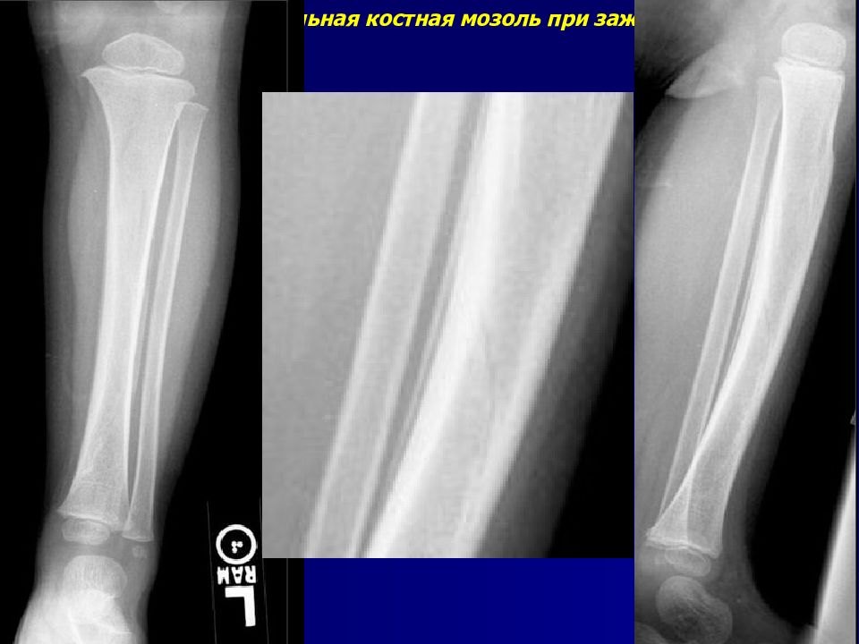 Костная мозоль у детей. Периостальная костная мозоль. Параоссальная костная мозоль. Эндостальная мозоль. Периостальная костная мозоль рентген.