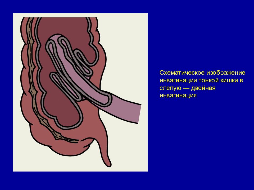 Инвагинация кишечника. Илеоцекальная инвагинация кишечника. Инвагинация слепой кишки кт. Слепо ободочная инвагинация. Инвагинация кишечника хирургические болезни.