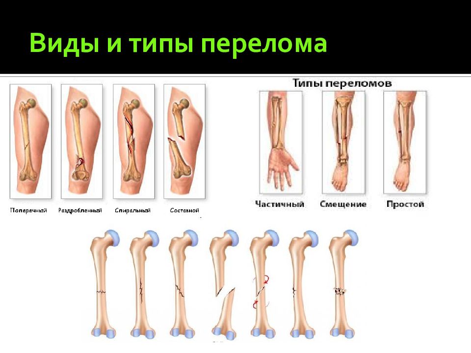 Установите соответствие между изображениями травм с их наименованиями