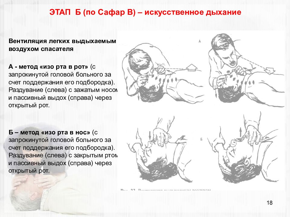 Искуственная вентиляция легких алгоритм кратко. Приемы искусственной вентиляции легких. Этапы проведения искусственного дыхания. Алгоритм проведения искусственной вентиляции легких. Схема искусственного дыхания.
