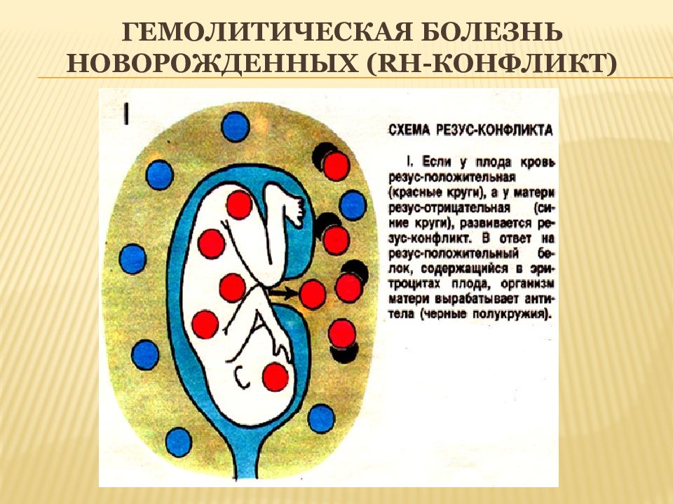 Гемолитическая болезнь новорожденных. Гемолитическая анемия плода. ГБН по резус системе. ГБН новорожденного этиология.