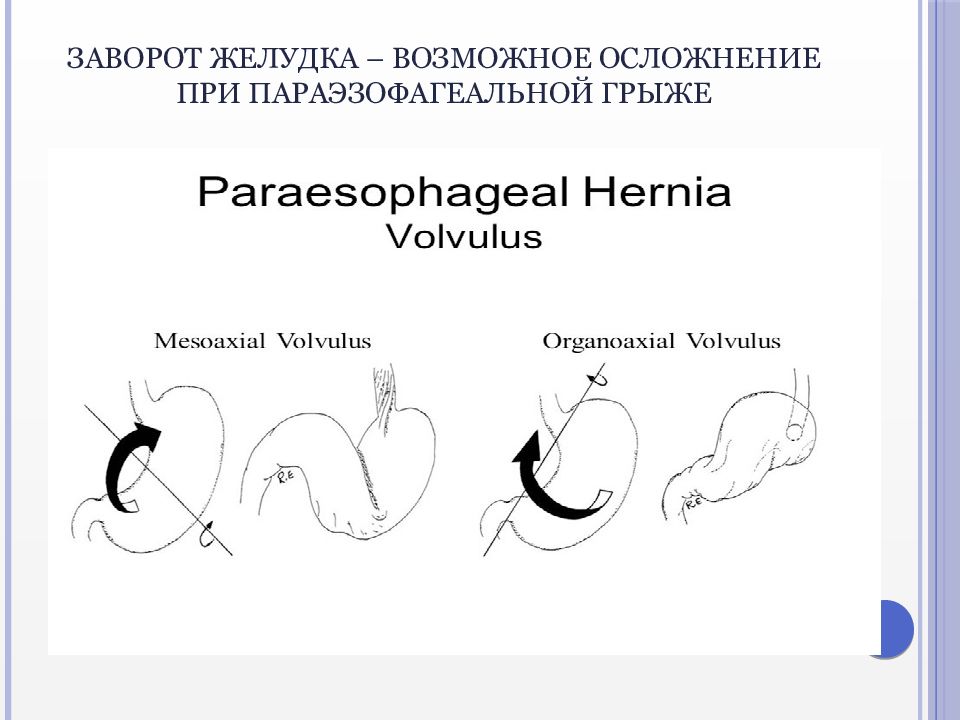 Схема лечения грыжи пищеводного отверстия диафрагмы