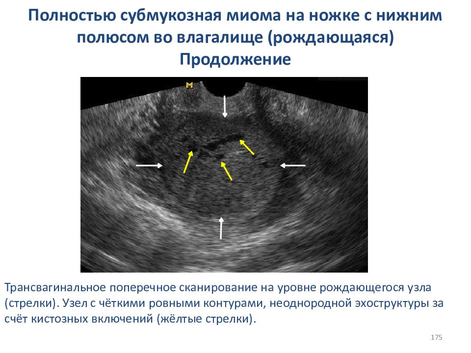 Миома на задней стенке матки. УЗИ субмукозной миомы матки. Рождающийся миоматозный узел на УЗИ.