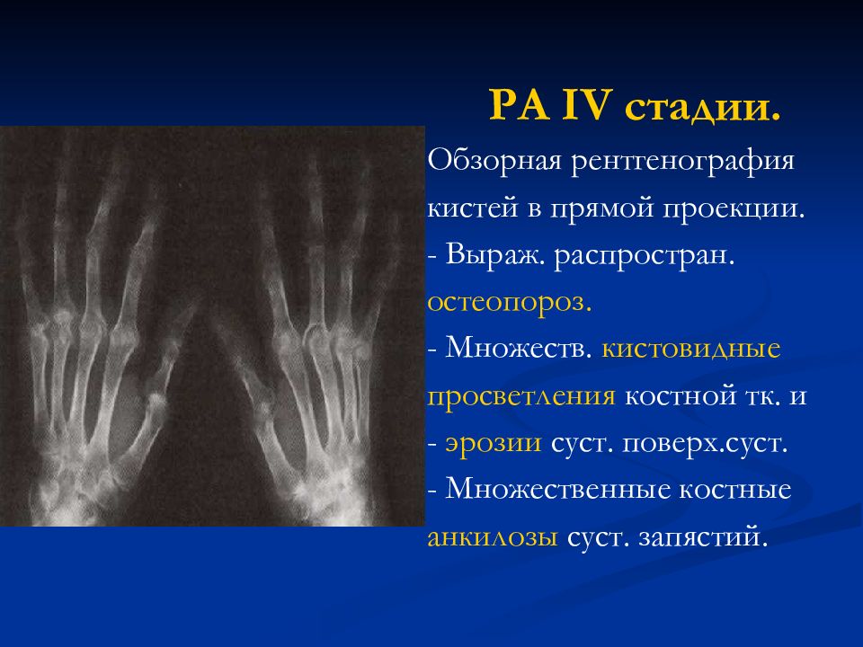 Анкилоз это. Анкилоз коленного сустава рентген. Анкилоз сустава рентген. Ревматоидный артрит анкилоз. Рентген кисти кистовидные просветления.