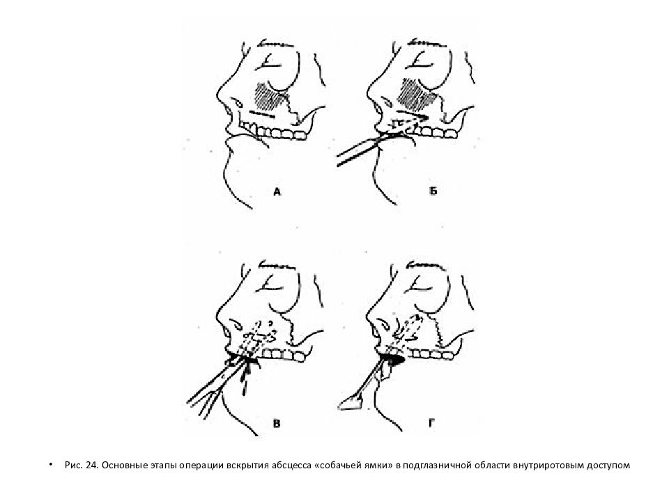 Абсцесс схема. Абсцесс и флегмона крылонебной ямки. Вскрытие ретробульбарной флегмоны. Собачья ямка верхней челюсти.