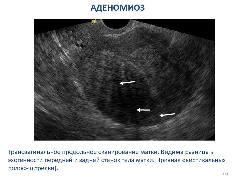 Структурные изменения матки. Внутренний эндометриоз матки на УЗИ. Внутренний эндометриоз на УЗИ. Эндометриоз аденомиоз матки.