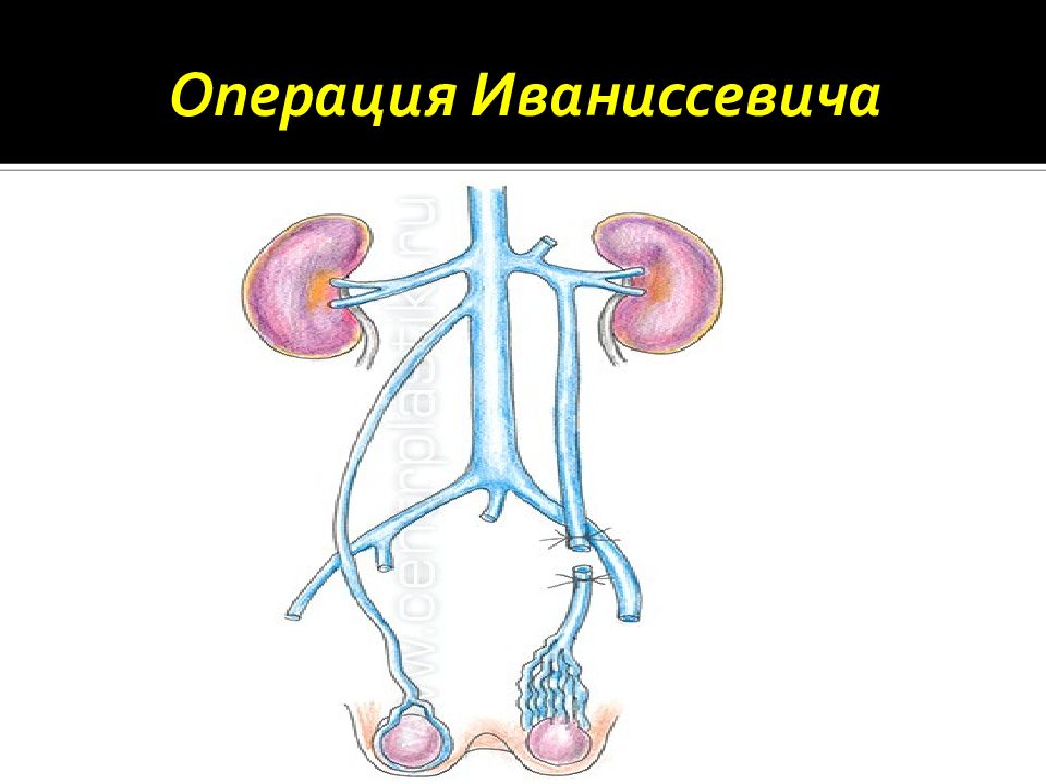 Варикоцеле ростов на дону