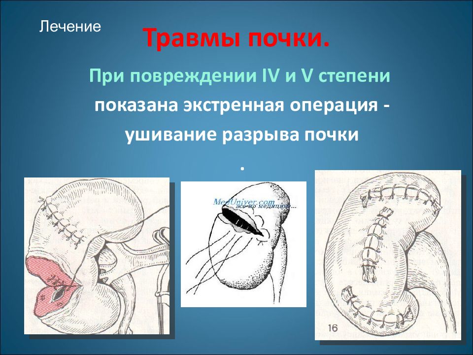 Травмы почек презентация