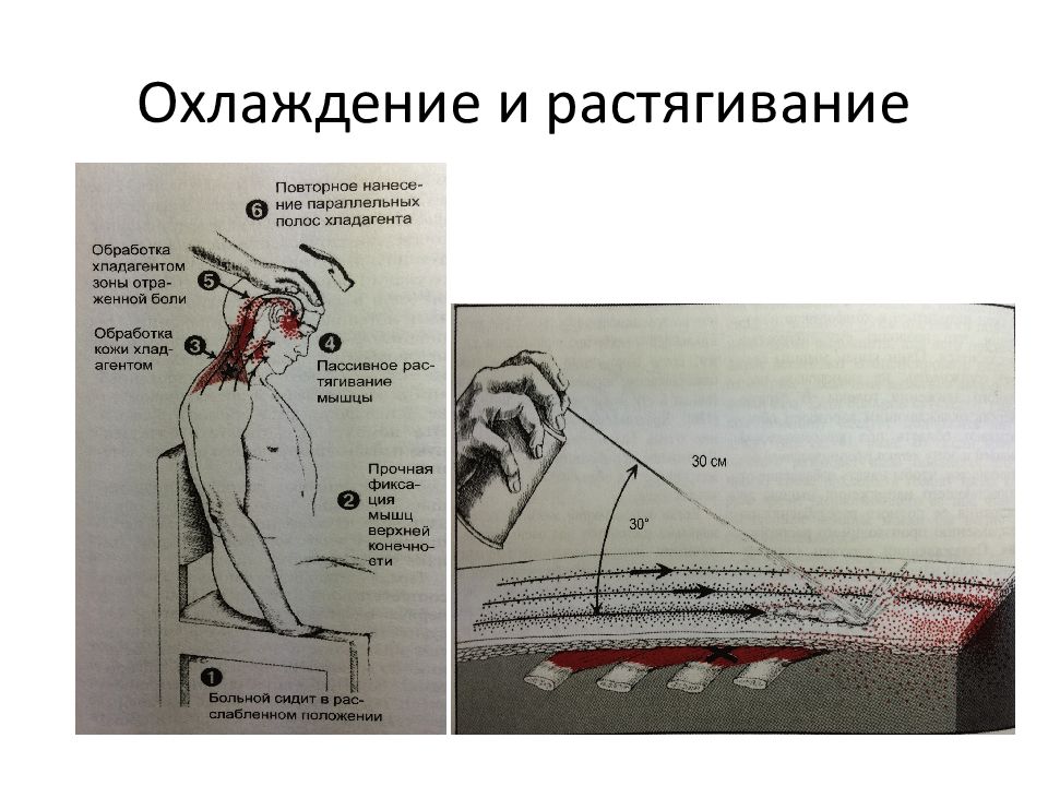 Миофасциальный болевой синдром презентация