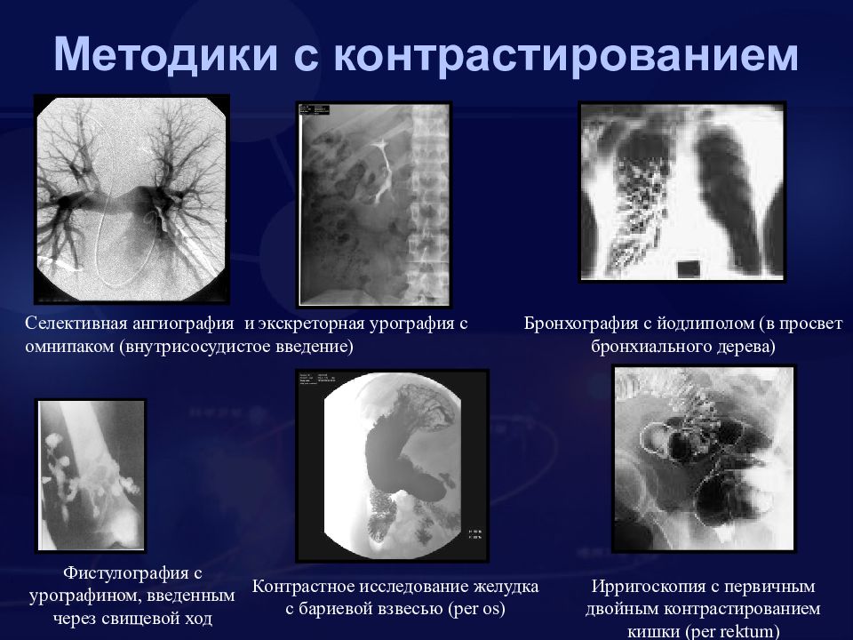 Контраст исследования. Методика внутривенного контрастирования. Селективная ангиография желудка. Ангиография лучевая диагностика. Контрастирование свищевого хода.