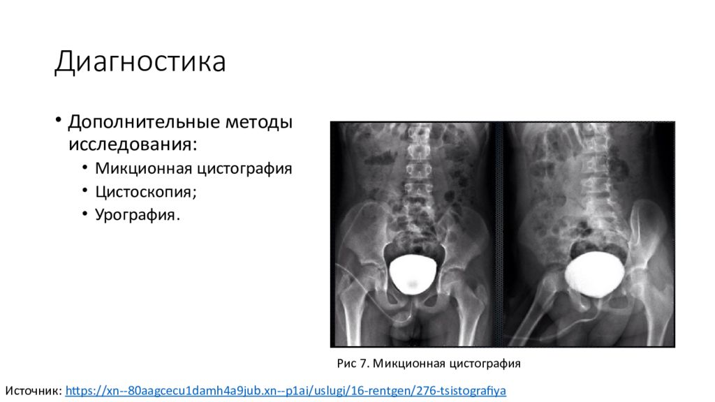 Цистография подготовка. Пузырно мочеточниковый рефлюкс цистография. Цистография мочевого пузыря рентген. Пузырно-мочеточниковый рефлюкс рентген.