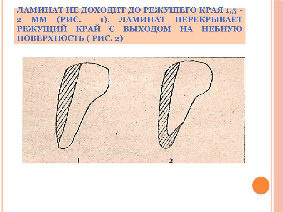 Режущий край. Адгезивная техника пломбирования. Нагрузка на режущий край зуба невелика.