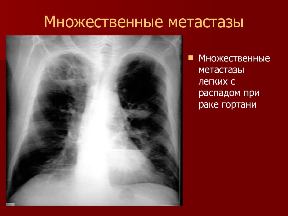 Метастазы при раке легких. Опухоль легкого с распадом. Множественные метастазы в легких. Единичный метастаз в легком. Рентгенодиагностика опухолей легких.