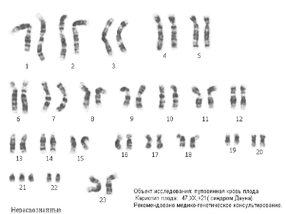 Кариотип синдрома дауна картинки