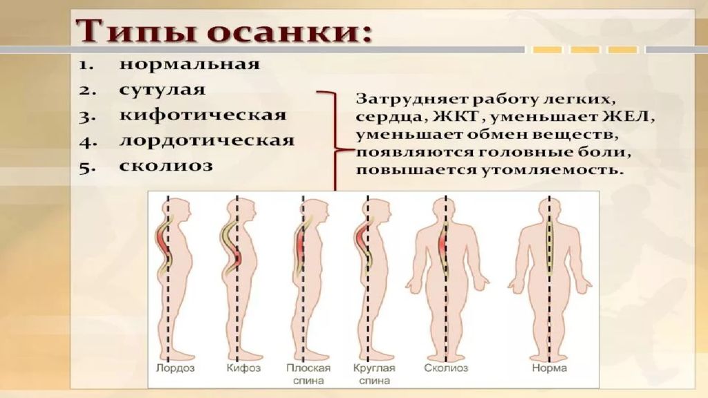 Нарушение осанки у детей. Нарушение осанки презентация. Нарушение осанки у детей презентация. Осанка нарушение осанки презентация. Виды неправильной осанки у детей.