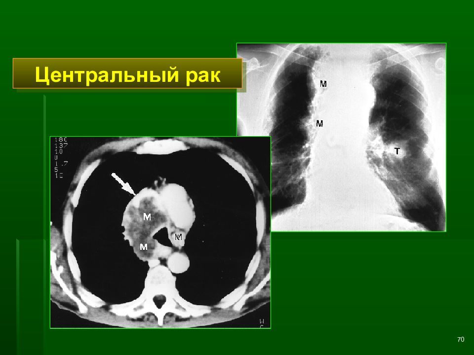 Лучевая диагностика рака легкого презентация