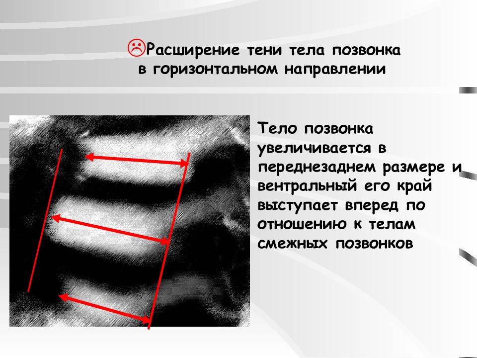 Компрессия тела позвонка. Снижение высоты тела позвонка. Высота тела позвонка. Ширина тела позвонка. Объем тела позвонка.