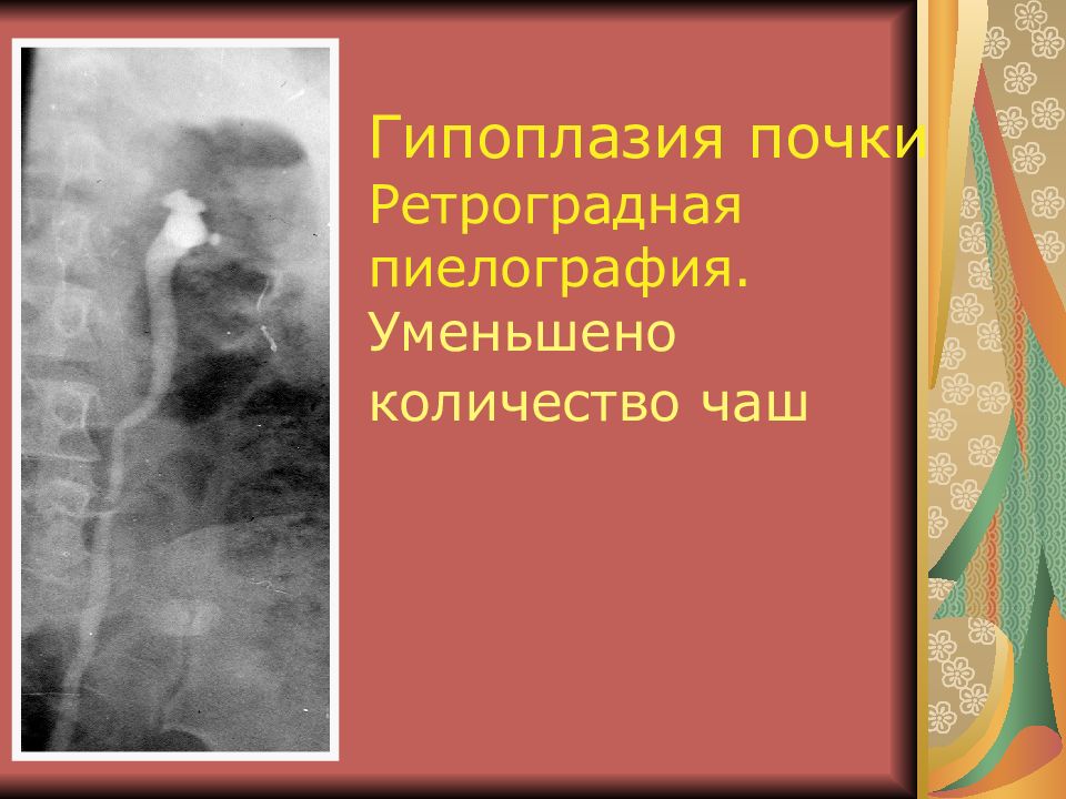 Гипоплазия почки. Гипоплазия правой почки. Критерии гипоплазии почки.