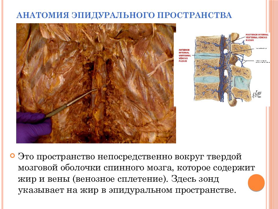 Пространство непосредственно. Анатомия эпидурального пространства. эпидуральное пространство спинного мозга. перидуральное пространство анатомия. переднее эпидуральное пространство позвоночника.