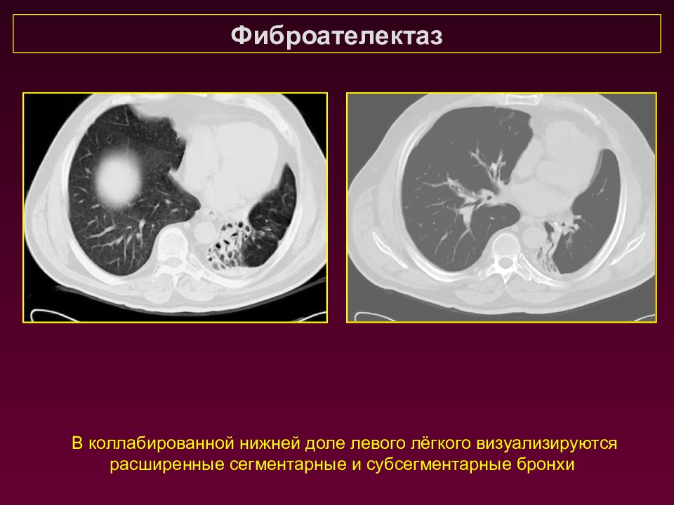 Картина кт картина пневмосклероза