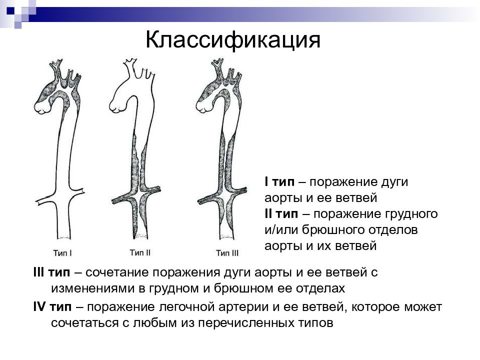 Синдром такаясу презентация