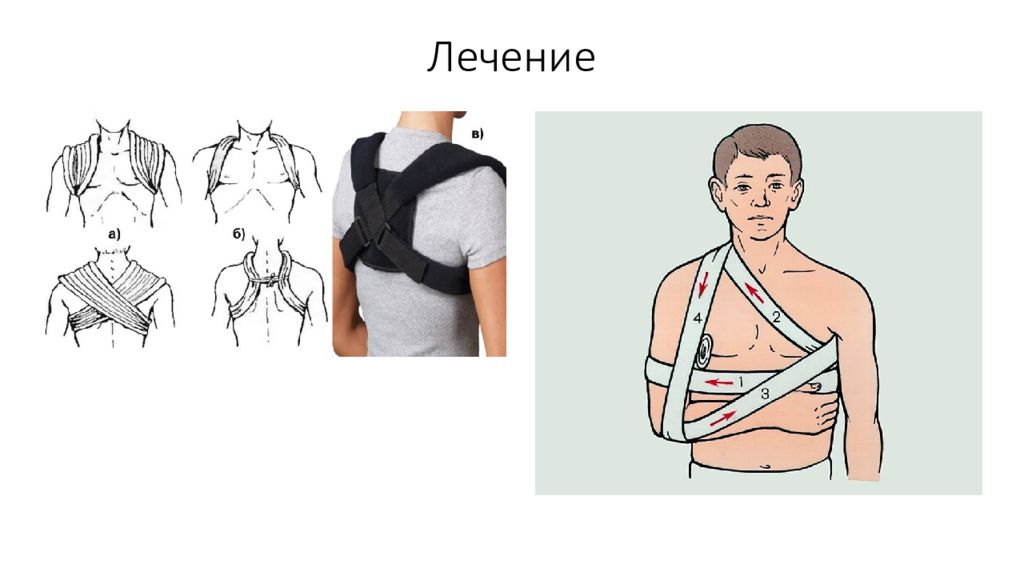 Перелом ключицы презентация