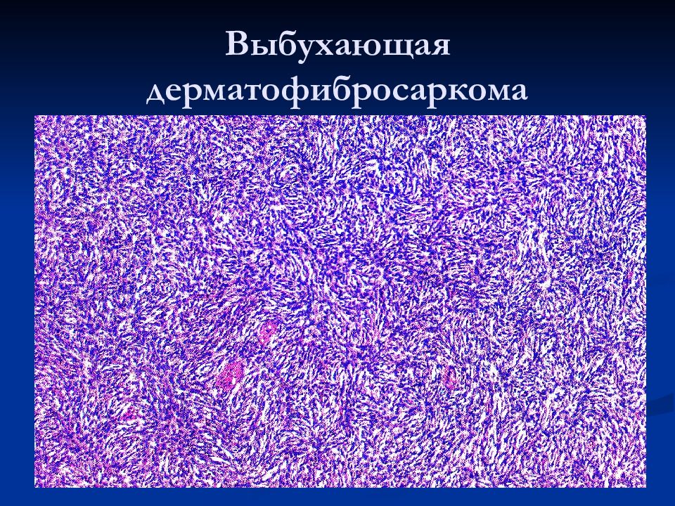 Мезенхимальные опухоли патанатомия презентация