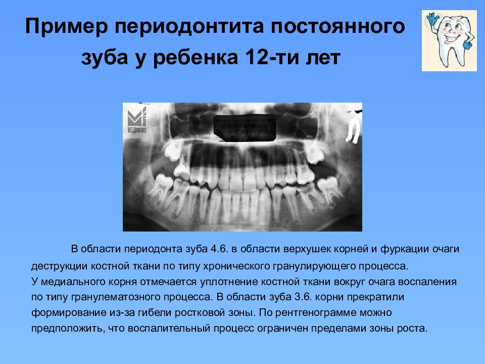 Рентгенологическая картина зубов и их зачатков на различных этапах формирования