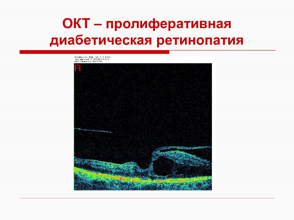 Оптическая томография. Окт при диабетической ретинопатии. Оптическая когерентная томография диабетическая ретинопатия. Пролиферативная ретинопатия окт. Окт презентация.