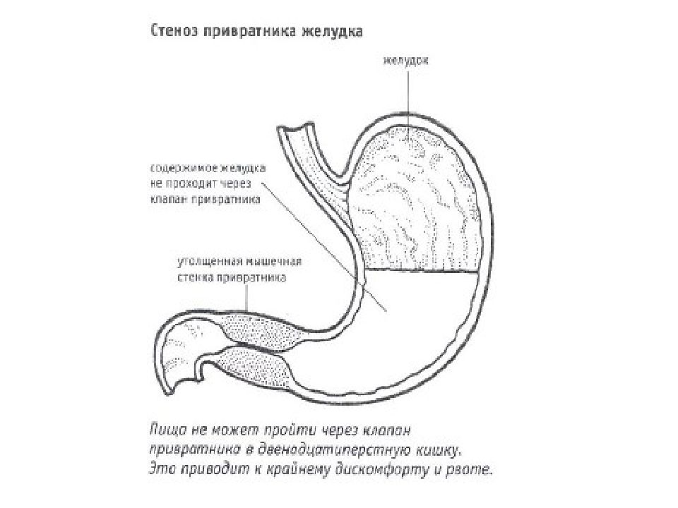 Стеноз привратника клиническая картина