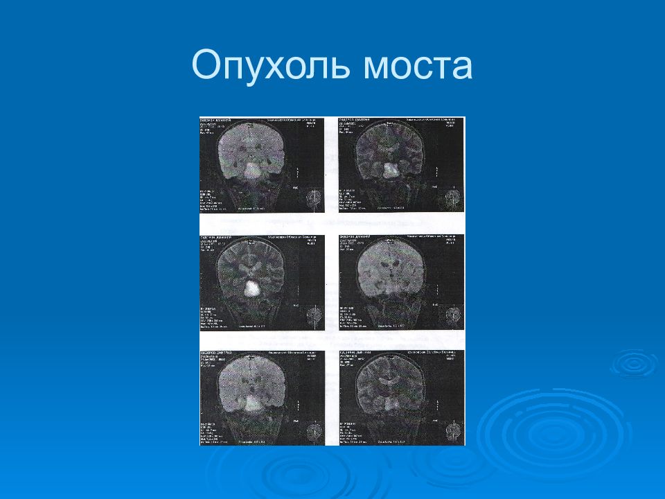 Опухоли нервной системы презентация