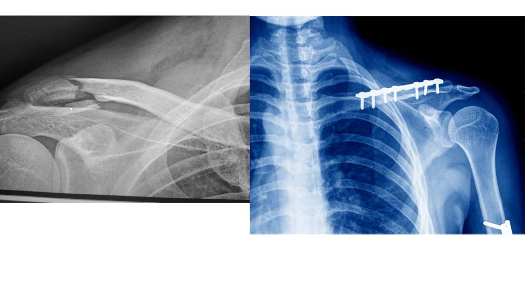 Перелом ключицы презентация