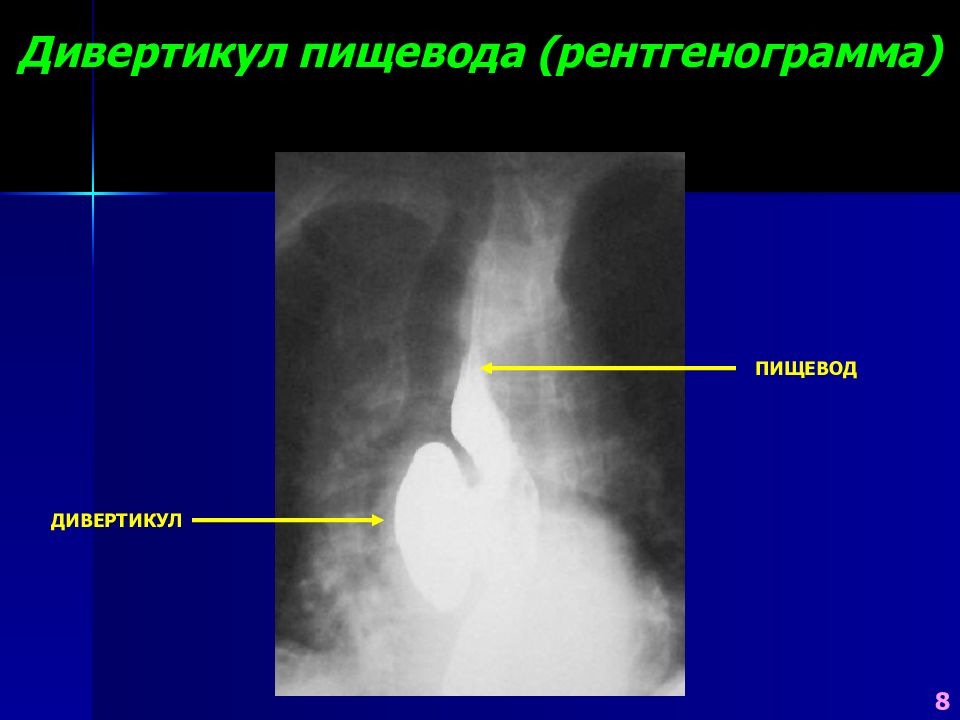 Диагностика дивертикула пищевода