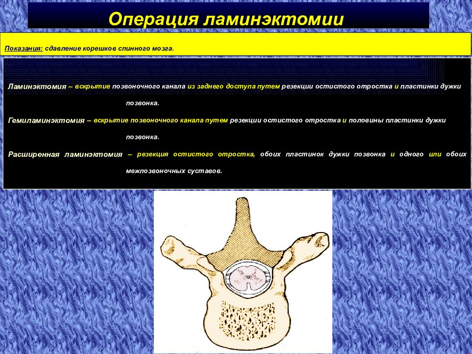 Операция позвонков. Операции на позвоночнике и спинном мозге. Вскрытие позвоночного канала. Ламинэктомия позвонков.