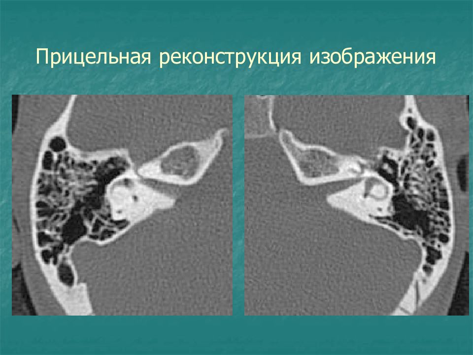 Реконструкция изображений в компьютерной томографии