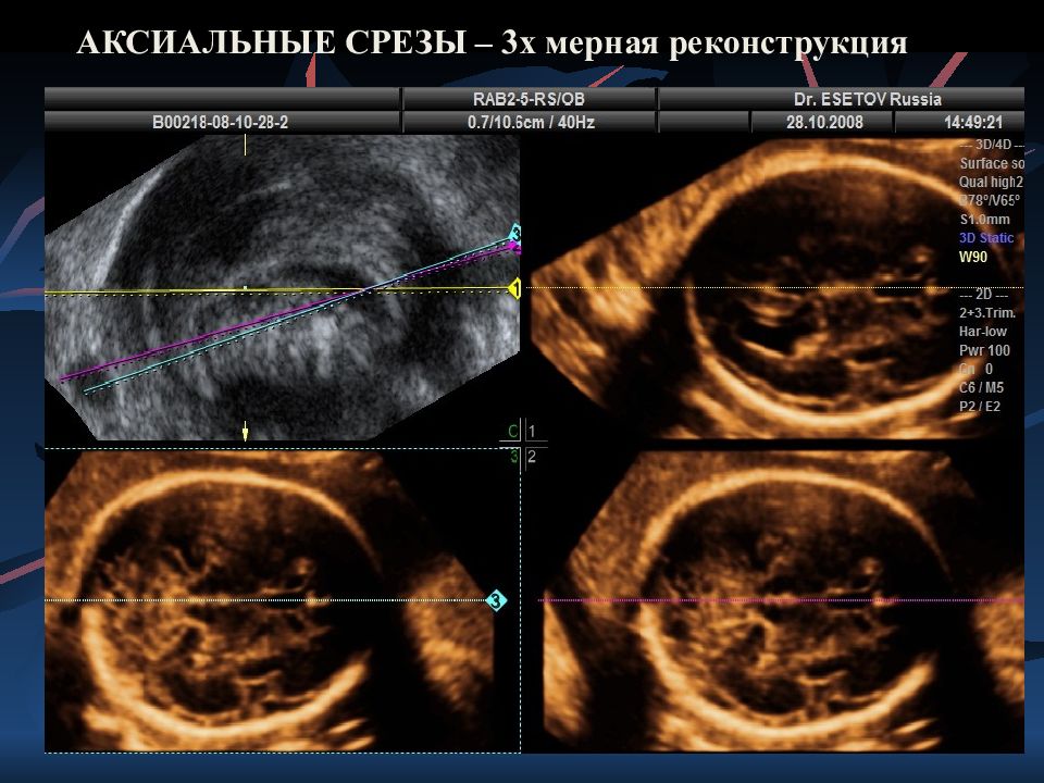 Получение 3х мерных и 4х мерных узи изображений